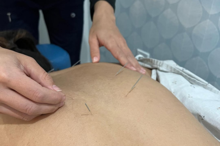 Acupuncture in Etobicoke