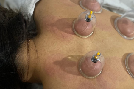 Cupping at Waterfront in etobicoke