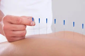 Acupuncture Treatment Etobicoke